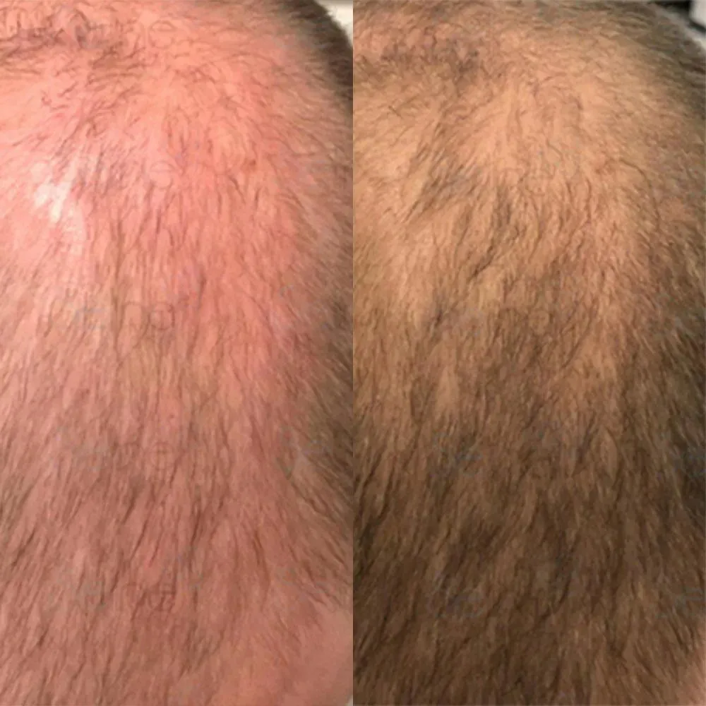 Panthrix hair growth serum (Redensyl) - Image 8
