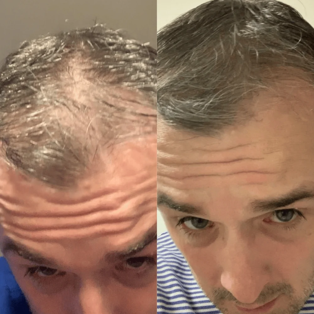 Scandinavian Biolabs Bio-Pilixin Hairline Booster - Image 6